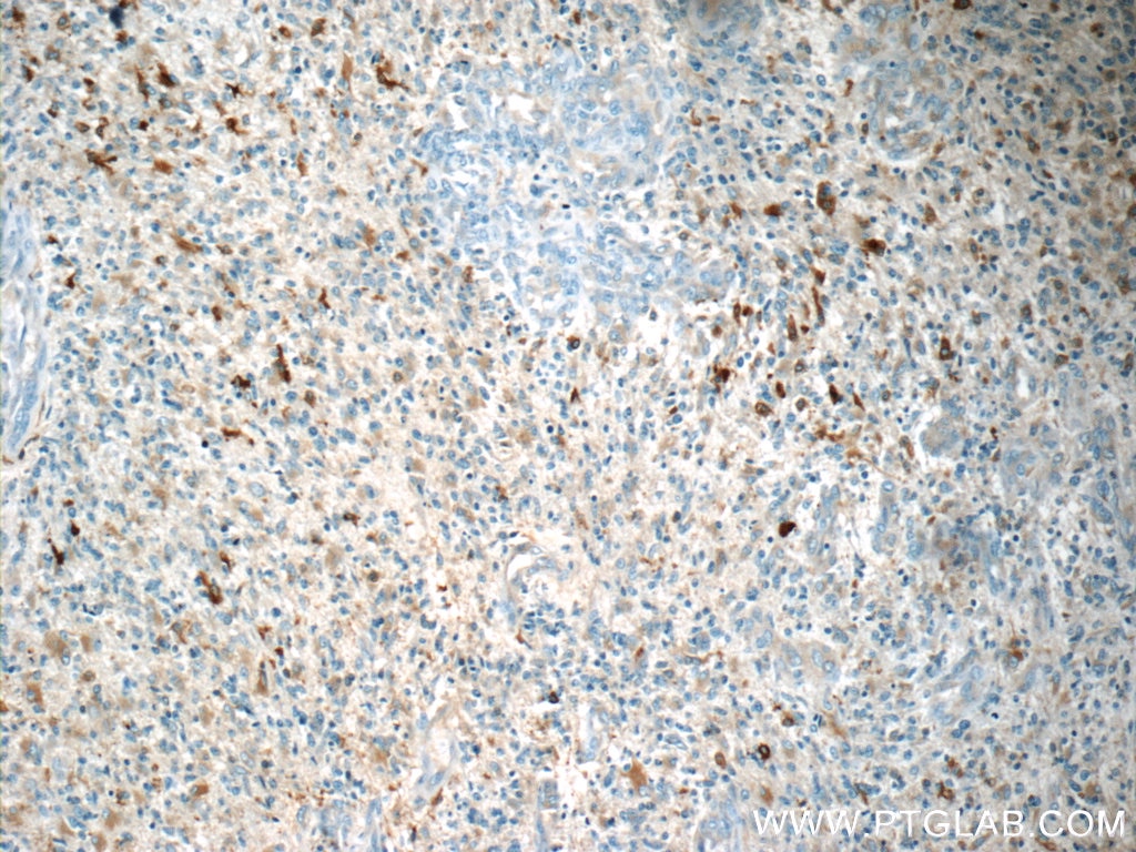 Immunohistochemistry (IHC) staining of human gliomas tissue using MARK4 Polyclonal antibody (20174-1-AP)