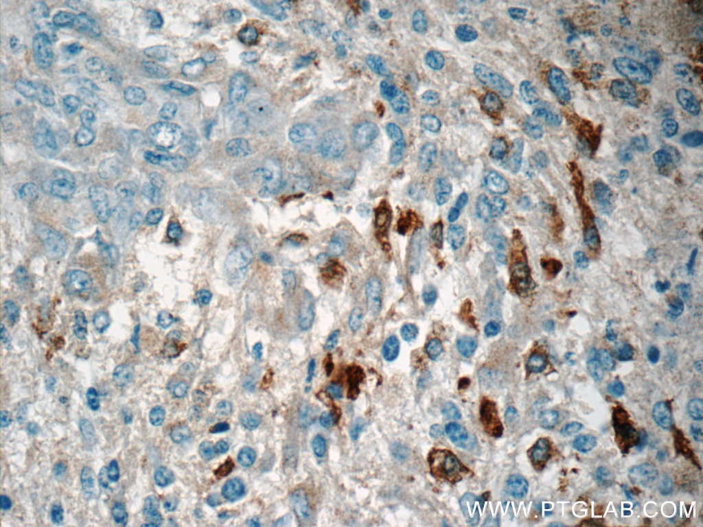 Immunohistochemistry (IHC) staining of human gliomas tissue using MARK4 Polyclonal antibody (20174-1-AP)