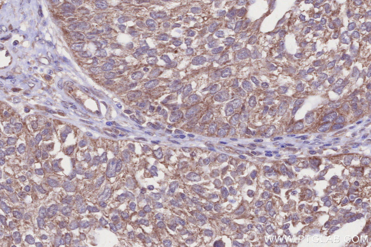 Immunohistochemistry (IHC) staining of human ovary cancer tissue using MARVELD2 Polyclonal antibody (13515-1-AP)