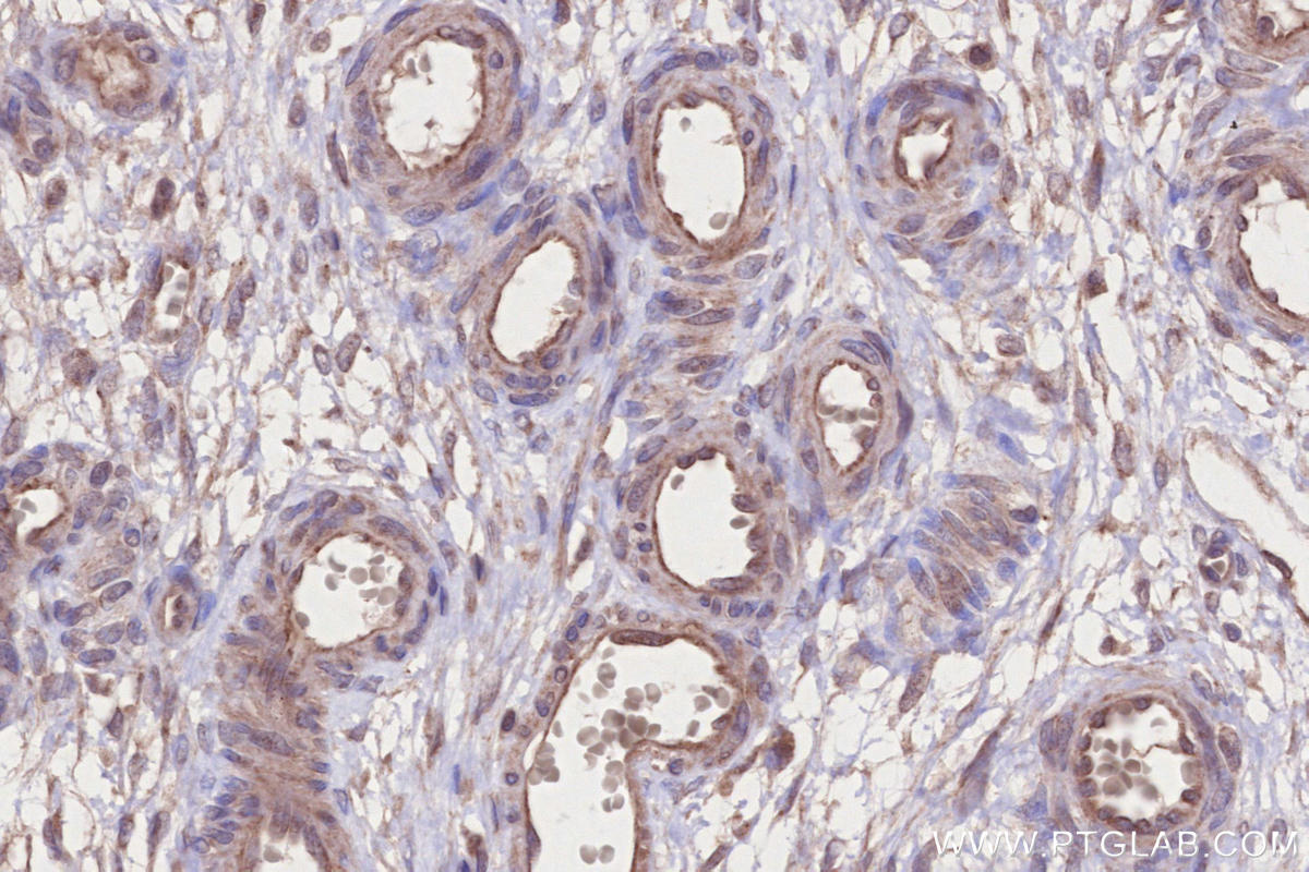 Immunohistochemistry (IHC) staining of human ovary cancer tissue using MARVELD2 Polyclonal antibody (13515-1-AP)
