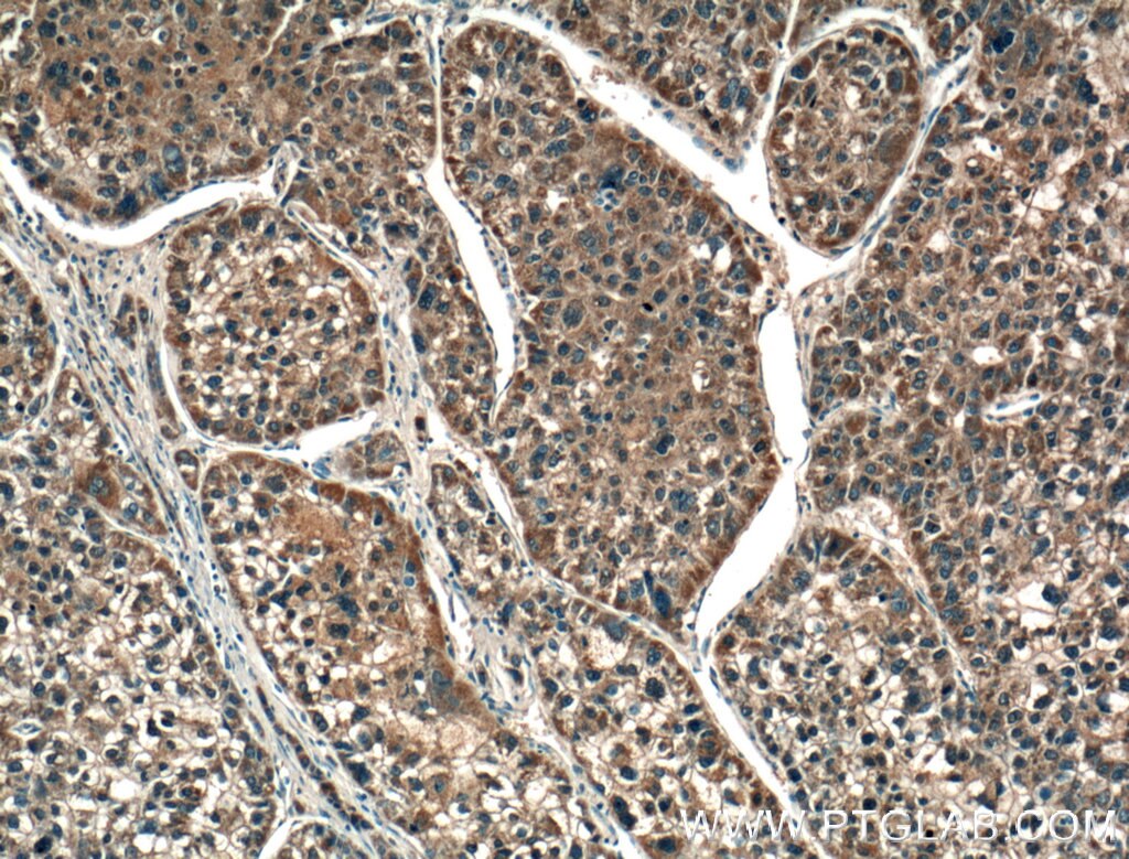 IHC staining of human liver cancer using 21837-1-AP