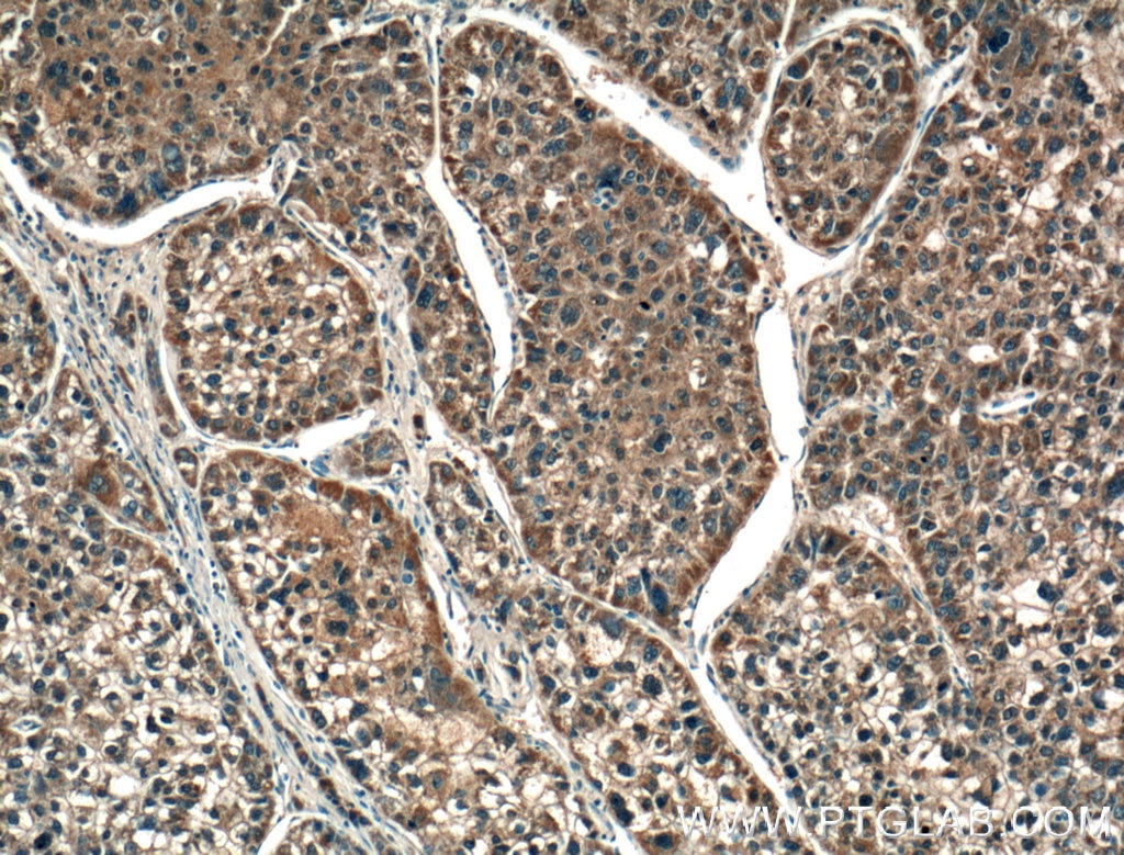 Immunohistochemistry (IHC) staining of human liver cancer tissue using MASP1 Polyclonal antibody (21837-1-AP)