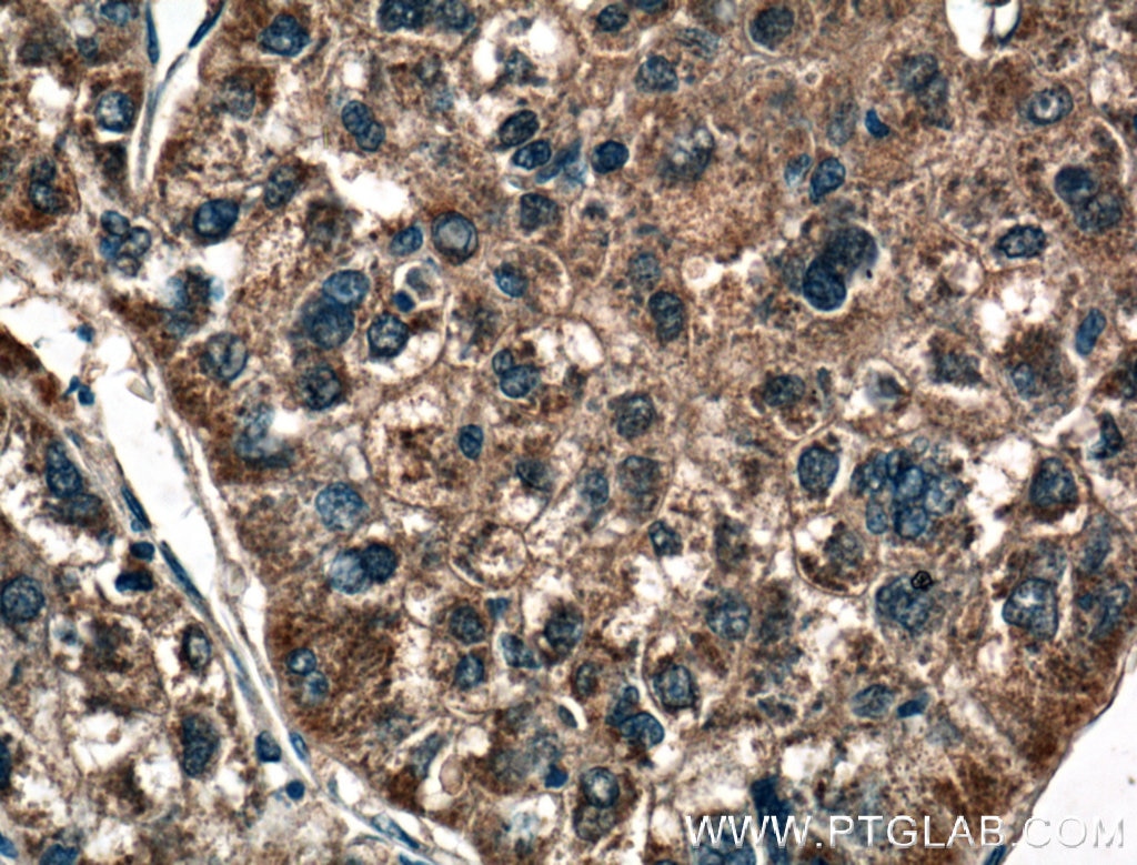 Immunohistochemistry (IHC) staining of human liver cancer tissue using MASP1 Polyclonal antibody (21837-1-AP)