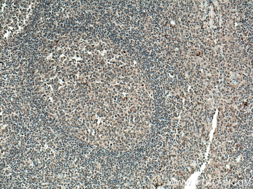 IHC staining of human tonsillitis using 15739-1-AP