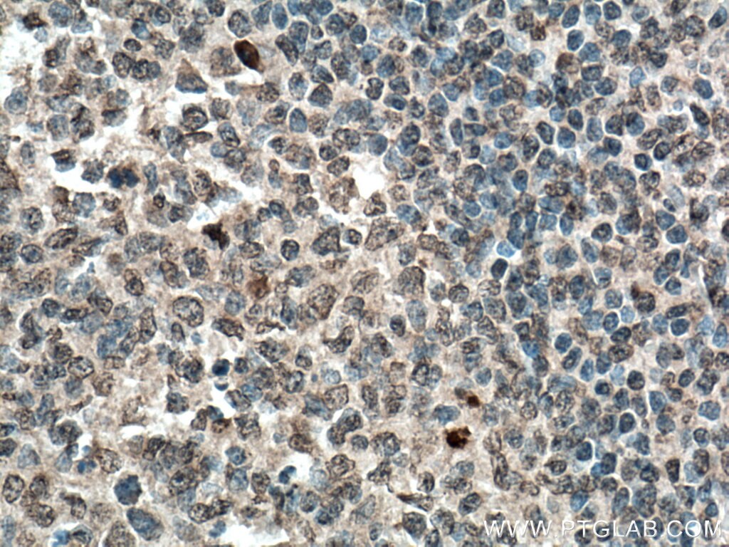 Immunohistochemistry (IHC) staining of human tonsillitis tissue using MASTL Polyclonal antibody (15739-1-AP)