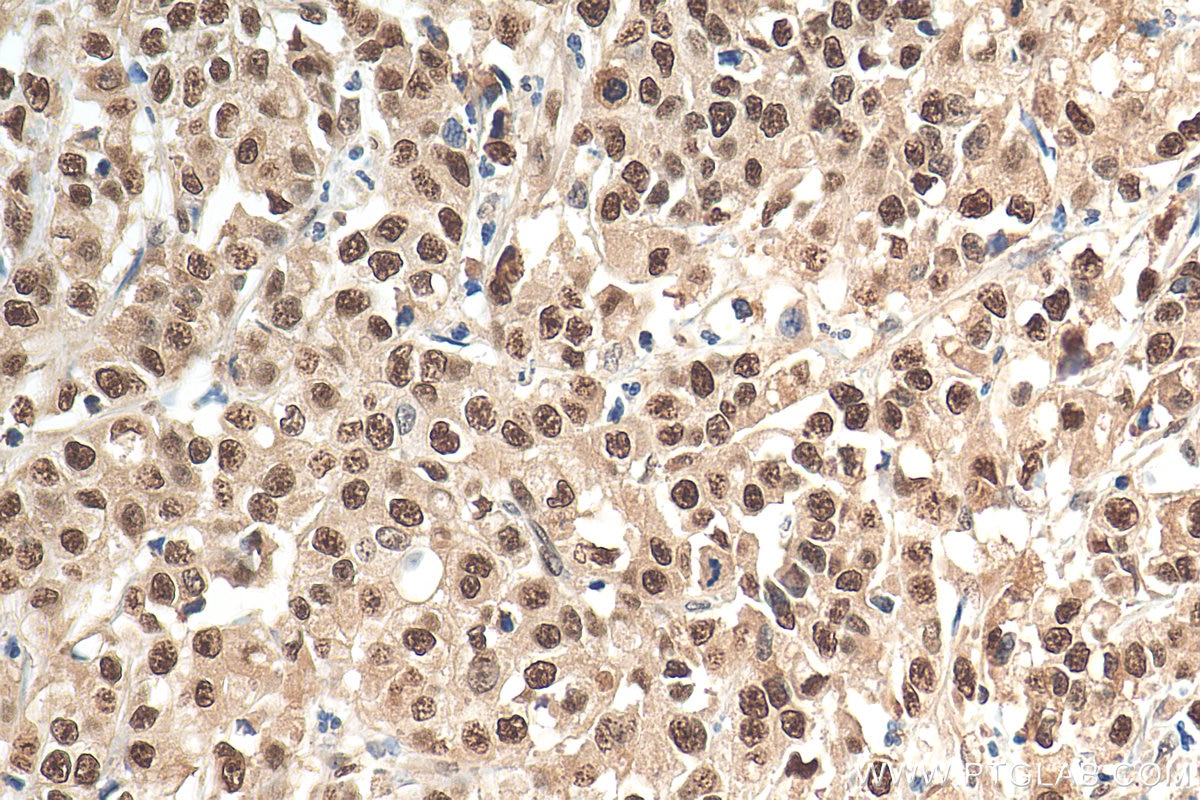 Immunohistochemistry (IHC) staining of human stomach cancer tissue using MAT2A Polyclonal antibody (55309-1-AP)
