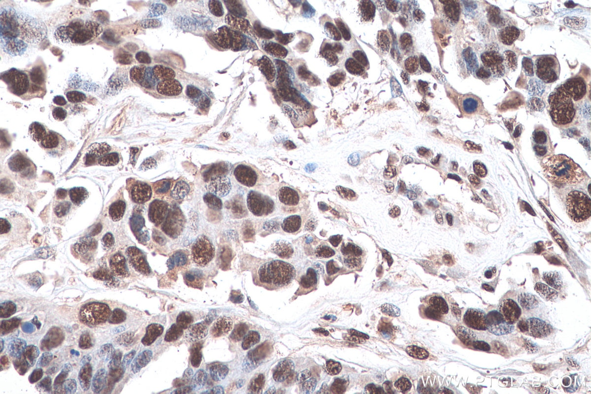 Immunohistochemistry (IHC) staining of human colon cancer tissue using MAT2A Polyclonal antibody (55309-1-AP)