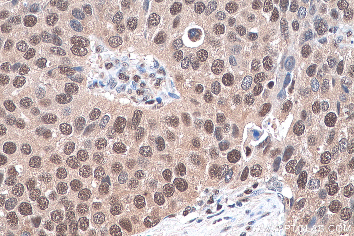 Immunohistochemistry (IHC) staining of human stomach cancer tissue using MAT2A Polyclonal antibody (55309-1-AP)