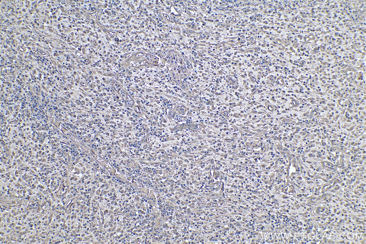 Immunohistochemistry (IHC) staining of human colon cancer tissue using MAT2B Monoclonal antibody (67643-1-Ig)