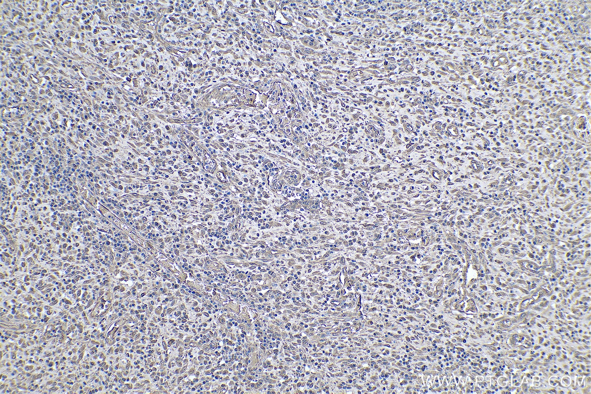 Immunohistochemistry (IHC) staining of human colon cancer tissue using MAT2B Monoclonal antibody (67643-1-Ig)