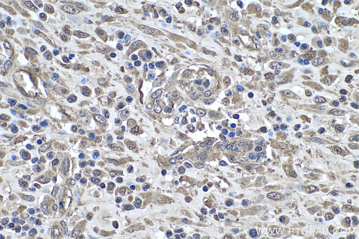 Immunohistochemistry (IHC) staining of human colon cancer tissue using MAT2B Monoclonal antibody (67643-1-Ig)
