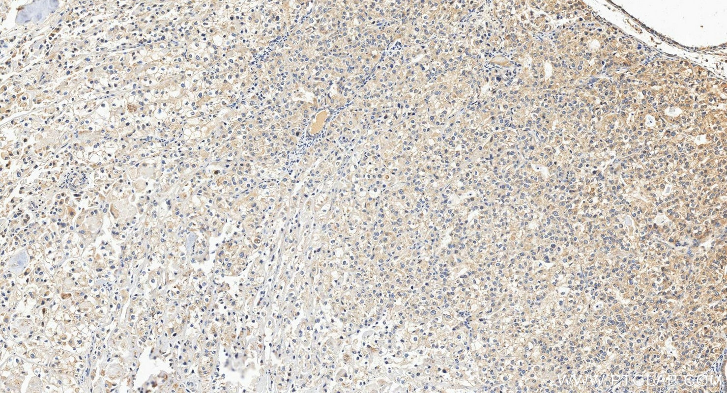 Immunohistochemistry (IHC) staining of human endometrial cancer tissue using MATE 2 Polyclonal antibody (26873-1-AP)