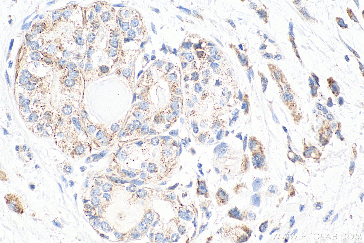 Immunohistochemistry (IHC) staining of human breast cancer tissue using MATK Polyclonal antibody (10082-2-AP)