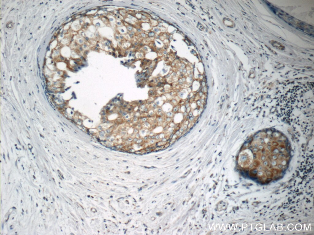 Immunohistochemistry (IHC) staining of human breast cancer tissue using MATK Polyclonal antibody (10082-2-AP)