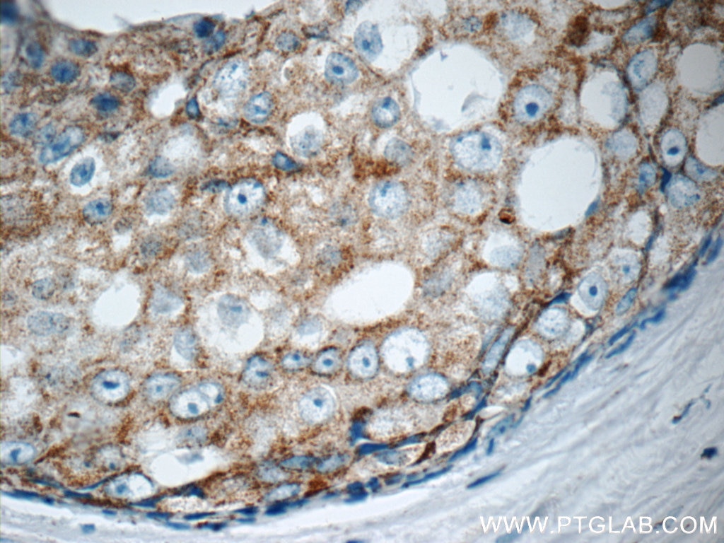 Immunohistochemistry (IHC) staining of human breast cancer tissue using MATK Polyclonal antibody (10082-2-AP)