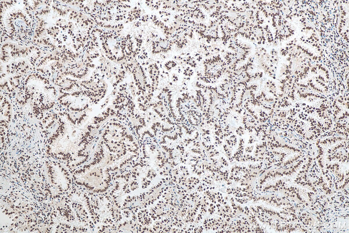Immunohistochemistry (IHC) staining of human lung cancer tissue using MATR3 Polyclonal antibody (12202-2-AP)