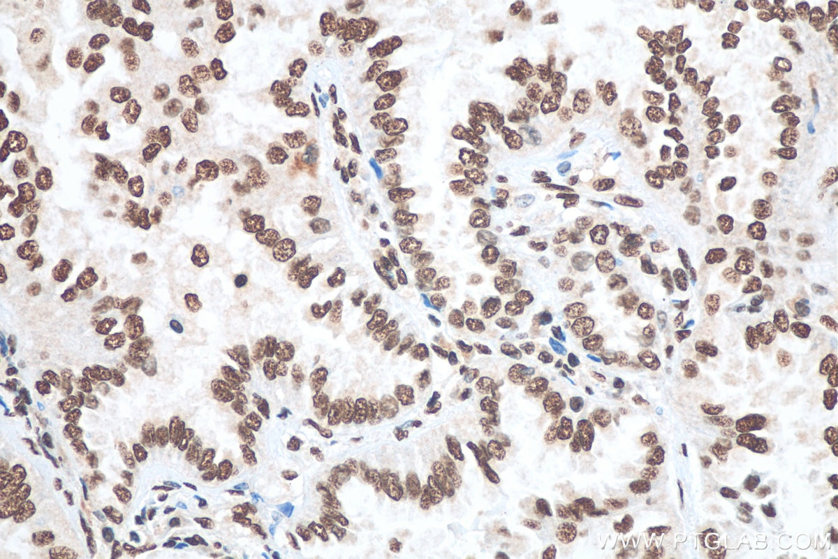 Immunohistochemistry (IHC) staining of human lung cancer tissue using MATR3 Polyclonal antibody (12202-2-AP)