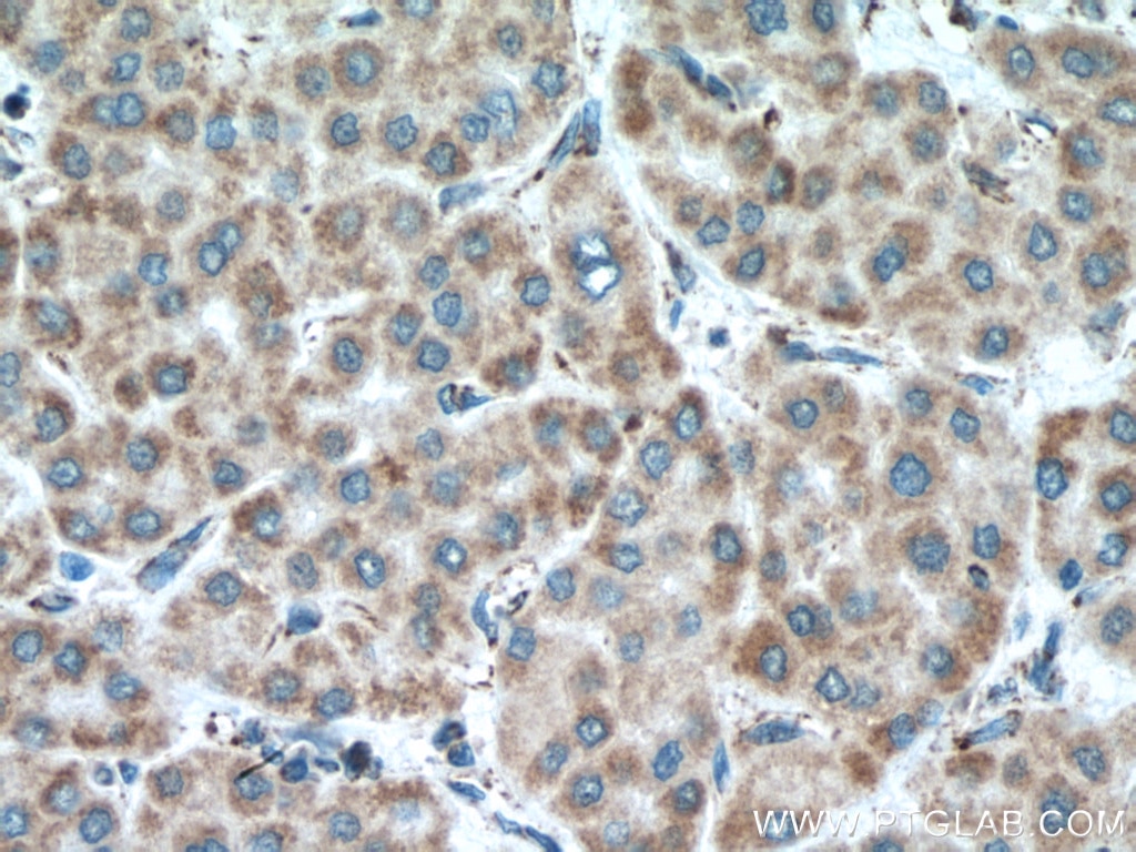 Immunohistochemistry (IHC) staining of human liver cancer tissue using MAVS; VISA Monoclonal antibody (66911-1-Ig)