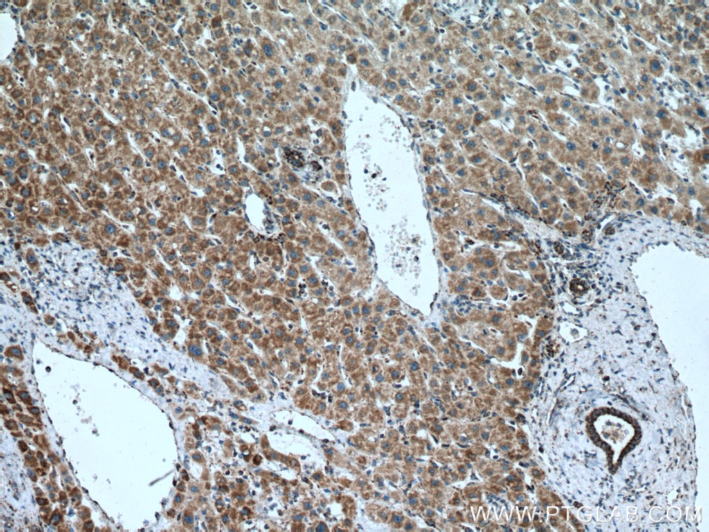 Immunohistochemistry (IHC) staining of human liver cancer tissue using MAVS; VISA Monoclonal antibody (66911-1-Ig)