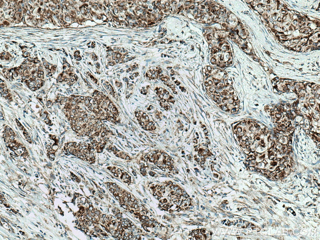 Immunohistochemistry (IHC) staining of human breast cancer tissue using MAVS; VISA Polyclonal antibody (14341-1-AP)