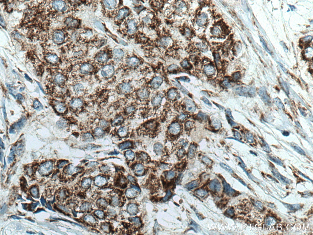 Immunohistochemistry (IHC) staining of human breast cancer tissue using MAVS; VISA Polyclonal antibody (14341-1-AP)