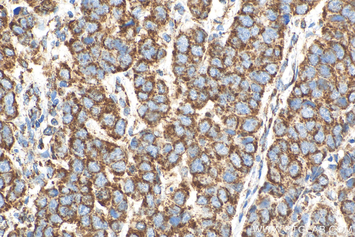 Immunohistochemistry (IHC) staining of human breast cancer tissue using MAVS; VISA Polyclonal antibody (14341-1-AP)
