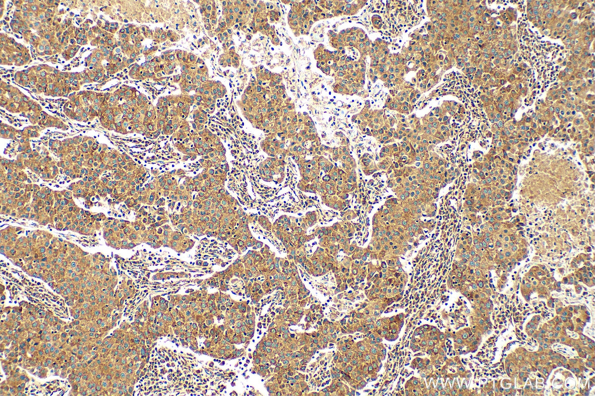 Immunohistochemistry (IHC) staining of human breast cancer tissue using MAVS; VISA Recombinant antibody (81910-1-RR)