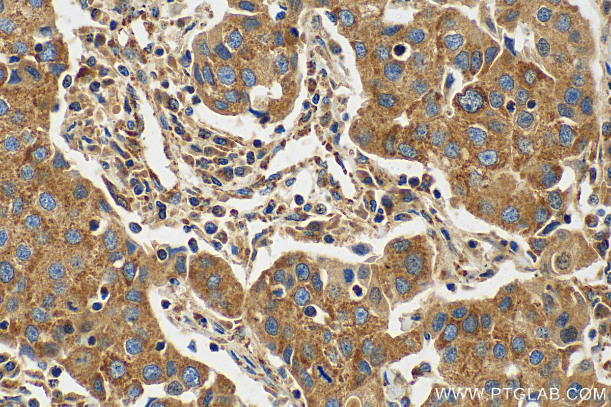 Immunohistochemistry (IHC) staining of human breast cancer tissue using MAVS; VISA Recombinant antibody (81910-1-RR)