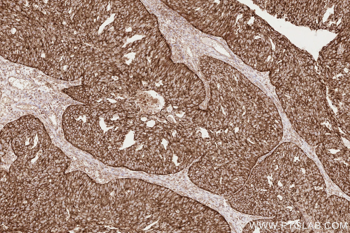 IHC staining of human ovary cancer using 81910-1-RR Immunohistochemistry (IHC) staining of human ovary cancer tissue using MAVS; VISA Recombinant monoclonal antibody (81910-1-RR)