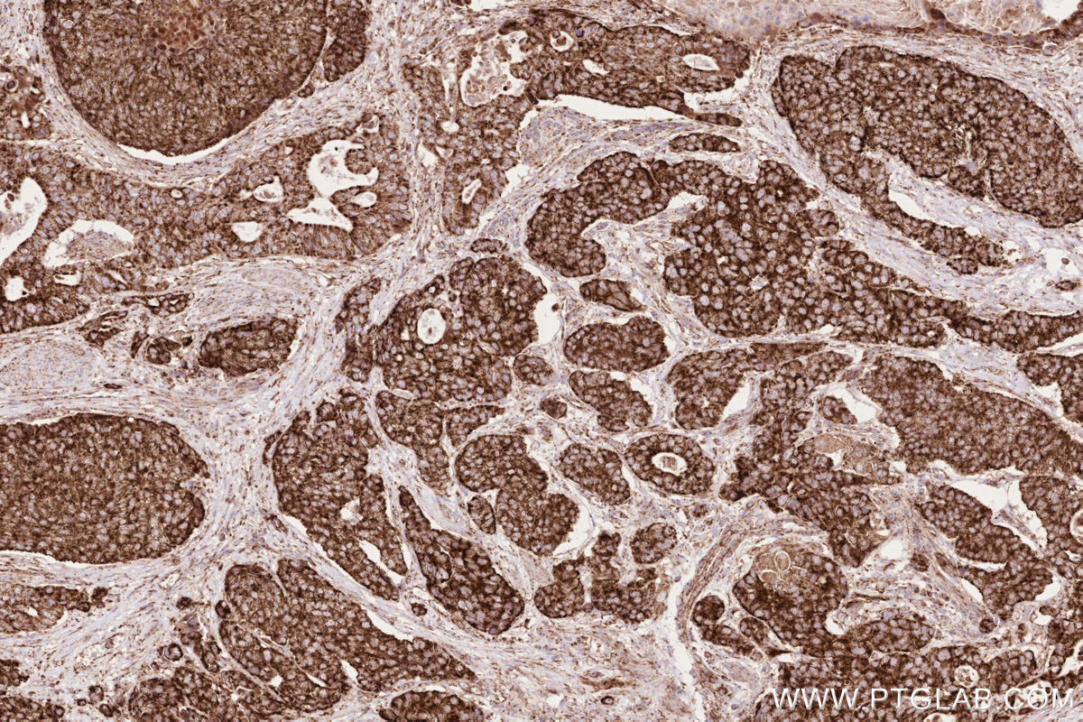 IHC staining of human stomach cancer using 81910-1-RR Immunohistochemistry (IHC) staining of human stomach cancer tissue using MAVS; VISA Recombinant monoclonal antibody (81910-1-RR)