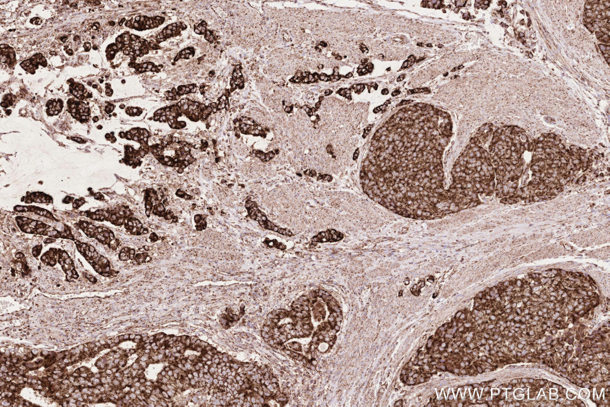 IHC staining of human stomach cancer using 81910-1-RR Immunohistochemistry (IHC) staining of human stomach cancer tissue using MAVS; VISA Recombinant monoclonal antibody (81910-1-RR)