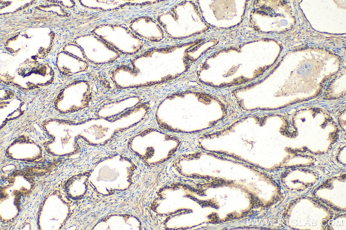 Immunohistochemistry (IHC) staining of human prostate cancer tissue using MAZ Recombinant antibody (82852-3-RR)