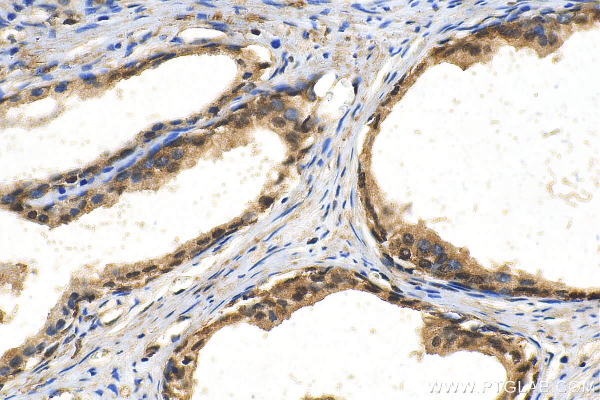 IHC staining of human prostate cancer using 82852-3-RR