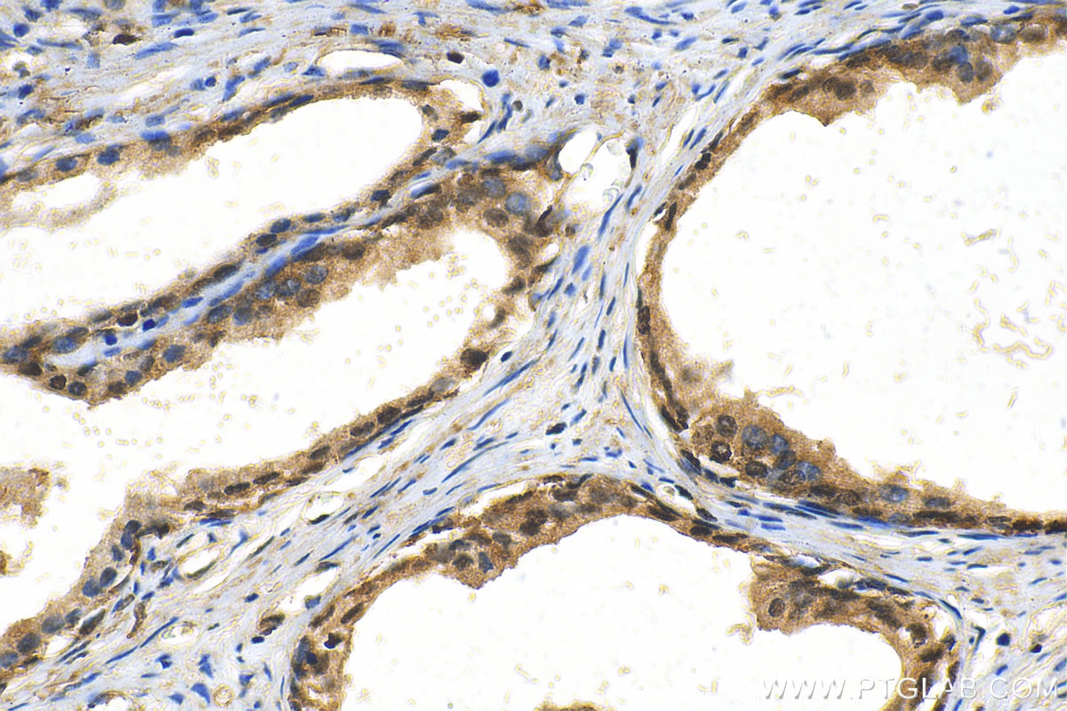 Immunohistochemistry (IHC) staining of human prostate cancer tissue using MAZ Recombinant antibody (82852-3-RR)