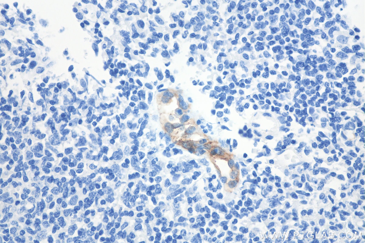 Immunohistochemistry (IHC) staining of human tonsillitis tissue using Biotin-conjugated MAdCAM1 Monoclonal antibody (Biotin-66594)