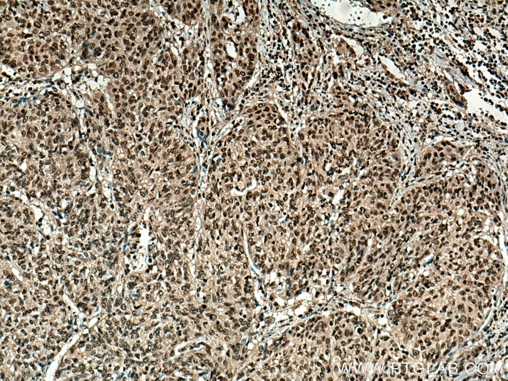 Immunohistochemistry (IHC) staining of human cervical cancer tissue using MBD2 Polyclonal antibody (55200-1-AP)