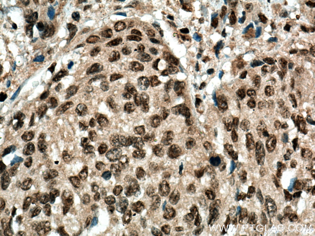 Immunohistochemistry (IHC) staining of human cervical cancer tissue using MBD2 Polyclonal antibody (55200-1-AP)