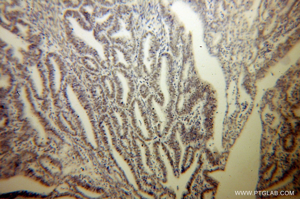Immunohistochemistry (IHC) staining of human endometrial cancer tissue using MBD3 Polyclonal antibody (14258-1-AP)
