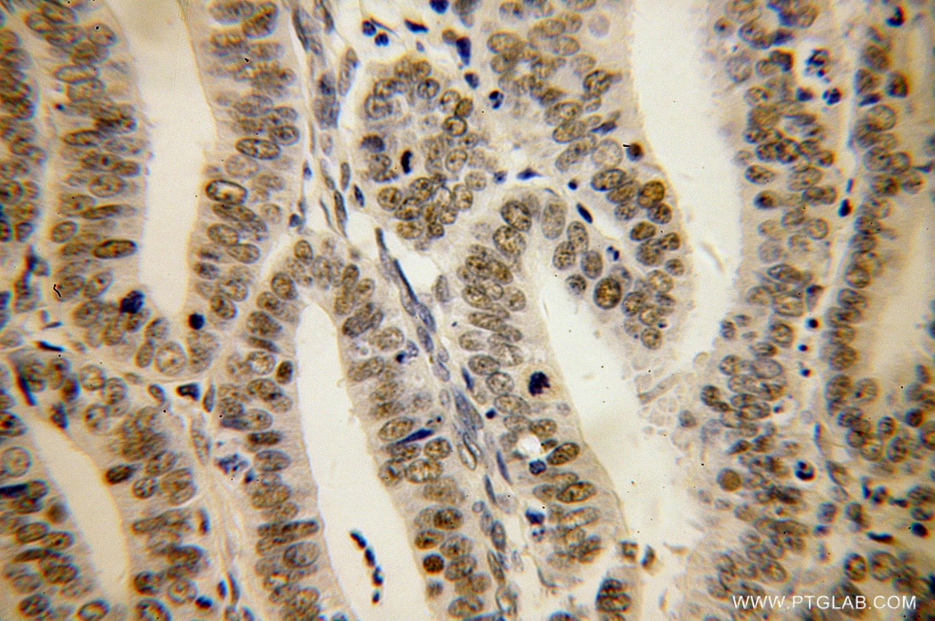 Immunohistochemistry (IHC) staining of human endometrial cancer tissue using MBD3 Polyclonal antibody (14258-1-AP)
