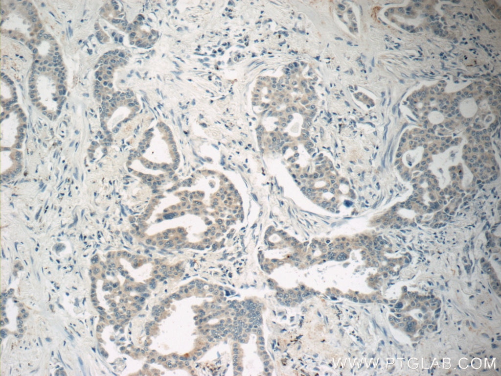 Immunohistochemistry (IHC) staining of human lung cancer tissue using MBIP Polyclonal antibody (10685-1-AP)