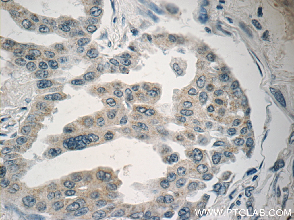 Immunohistochemistry (IHC) staining of human lung cancer tissue using MBIP Polyclonal antibody (10685-1-AP)