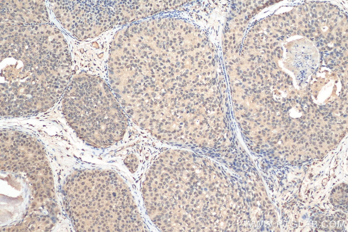 Immunohistochemistry (IHC) staining of human breast cancer tissue using MBNL1 Monoclonal antibody (66837-1-Ig)