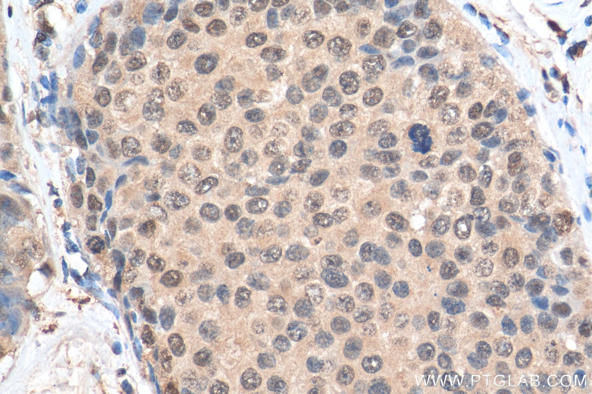 Immunohistochemistry (IHC) staining of human breast cancer tissue using MBNL1 Monoclonal antibody (66837-1-Ig)