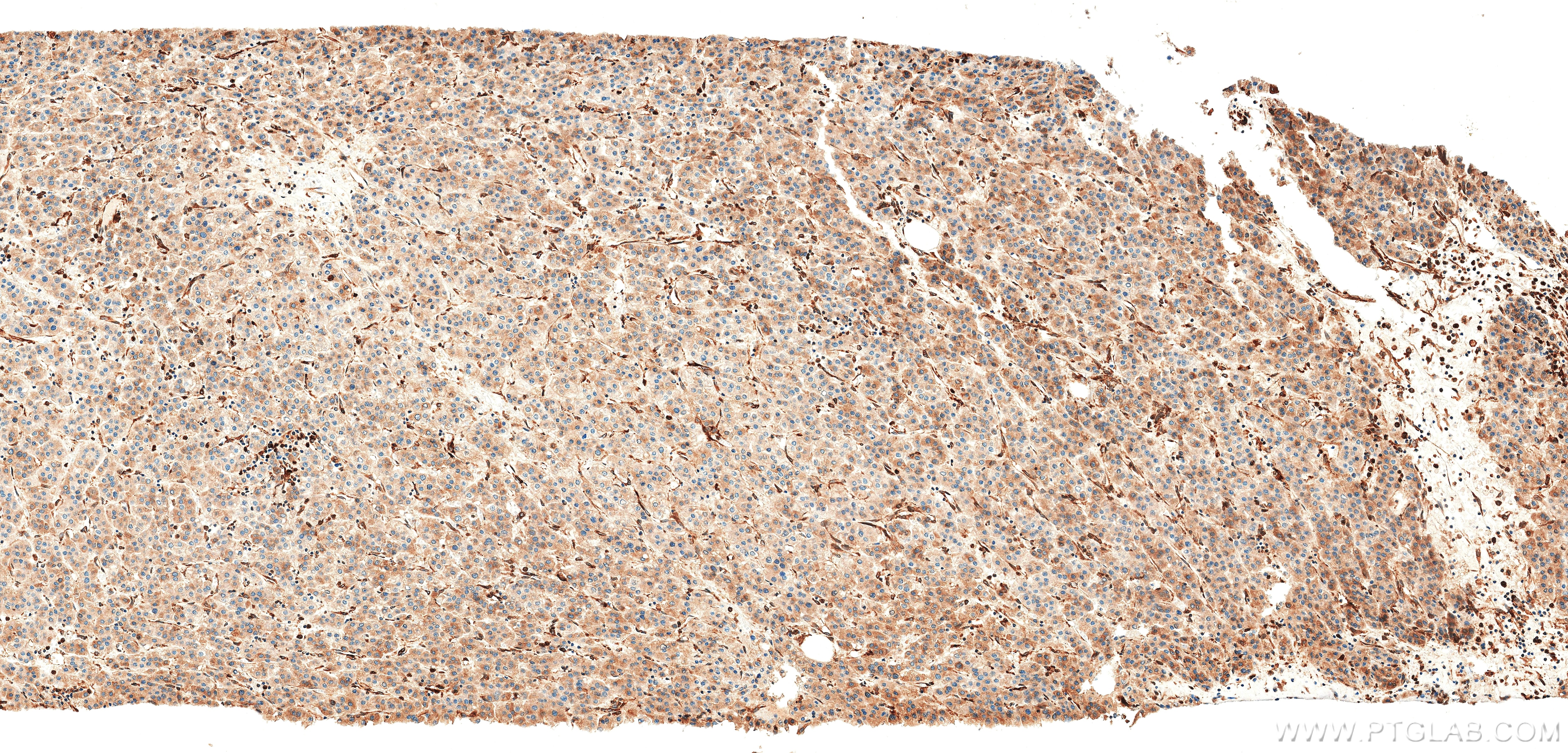 Immunohistochemistry (IHC) staining of Human Hepatocellular cancer using MBOAT7 Recombinant monoclonal antibody, PBS Only (83546-3-PBS)