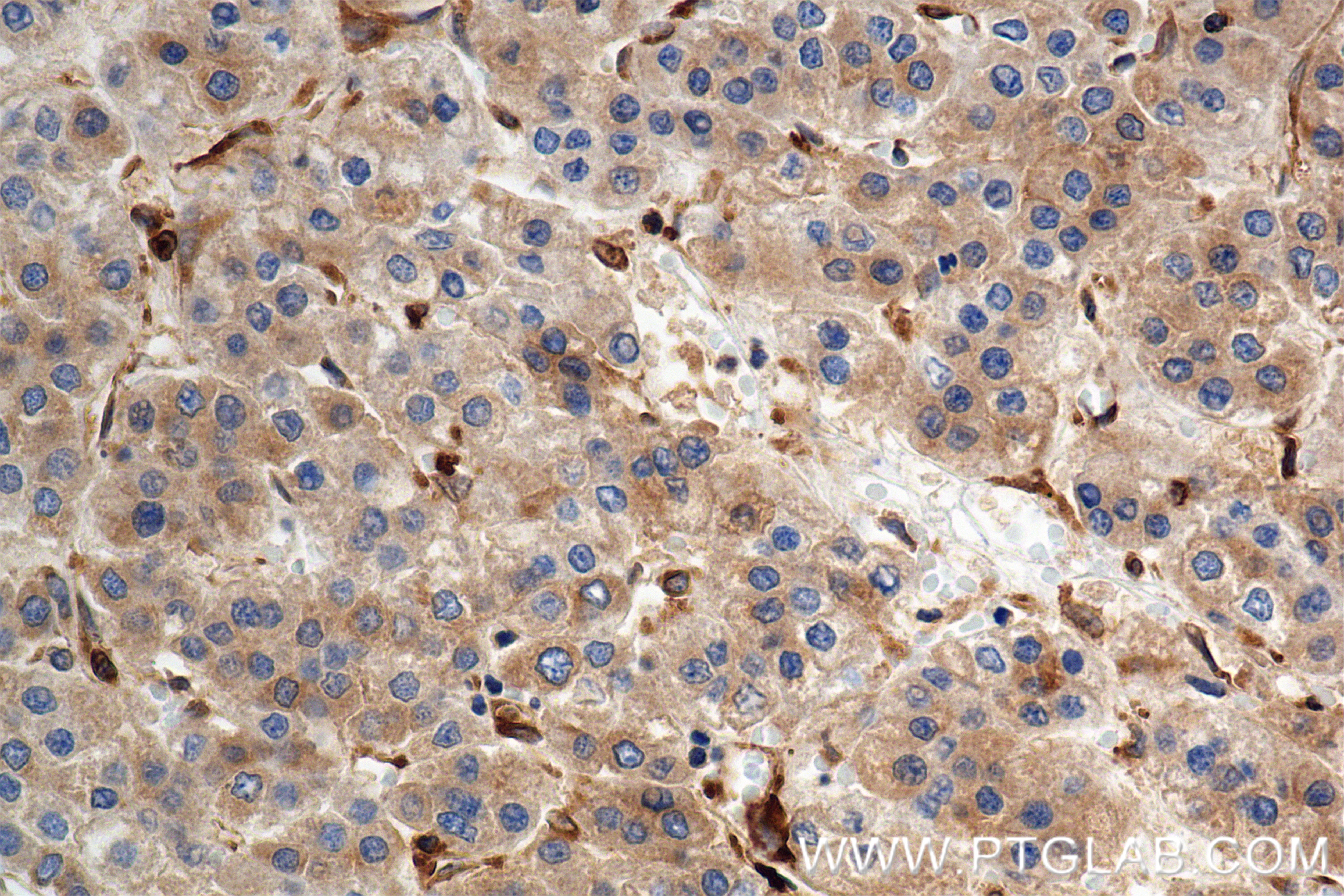 Immunohistochemistry (IHC) staining of Human Hepatocellular cancer using MBOAT7 Recombinant monoclonal antibody, PBS Only (83546-3-PBS)