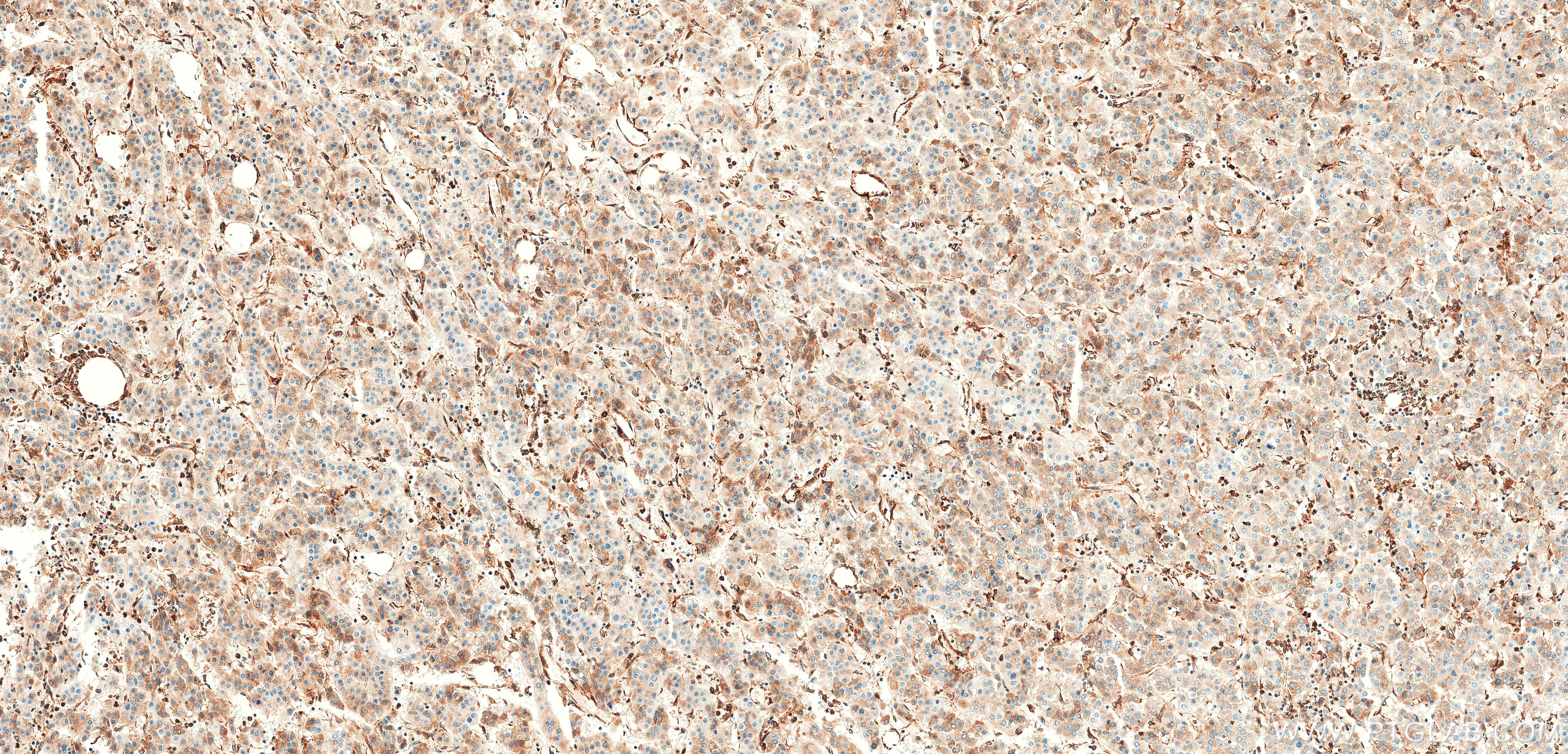Immunohistochemistry (IHC) staining of Human Hepatocellular cancer using MBOAT7 Recombinant monoclonal antibody (83546-3-RR)