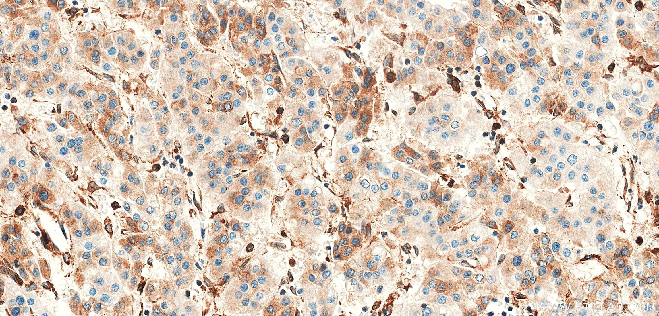 Immunohistochemistry (IHC) staining of Human Hepatocellular cancer using MBOAT7 Recombinant monoclonal antibody (83546-3-RR)