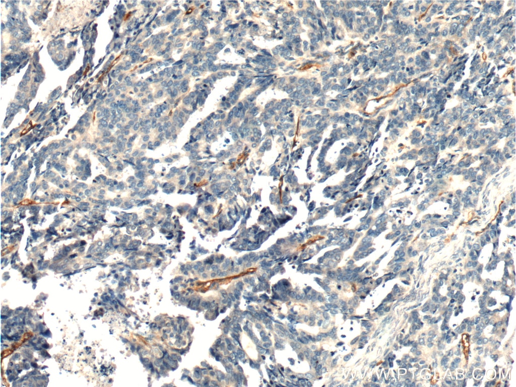 Immunohistochemistry (IHC) staining of human ovary tumor tissue using CD146/MCAM Polyclonal antibody (17564-1-AP)