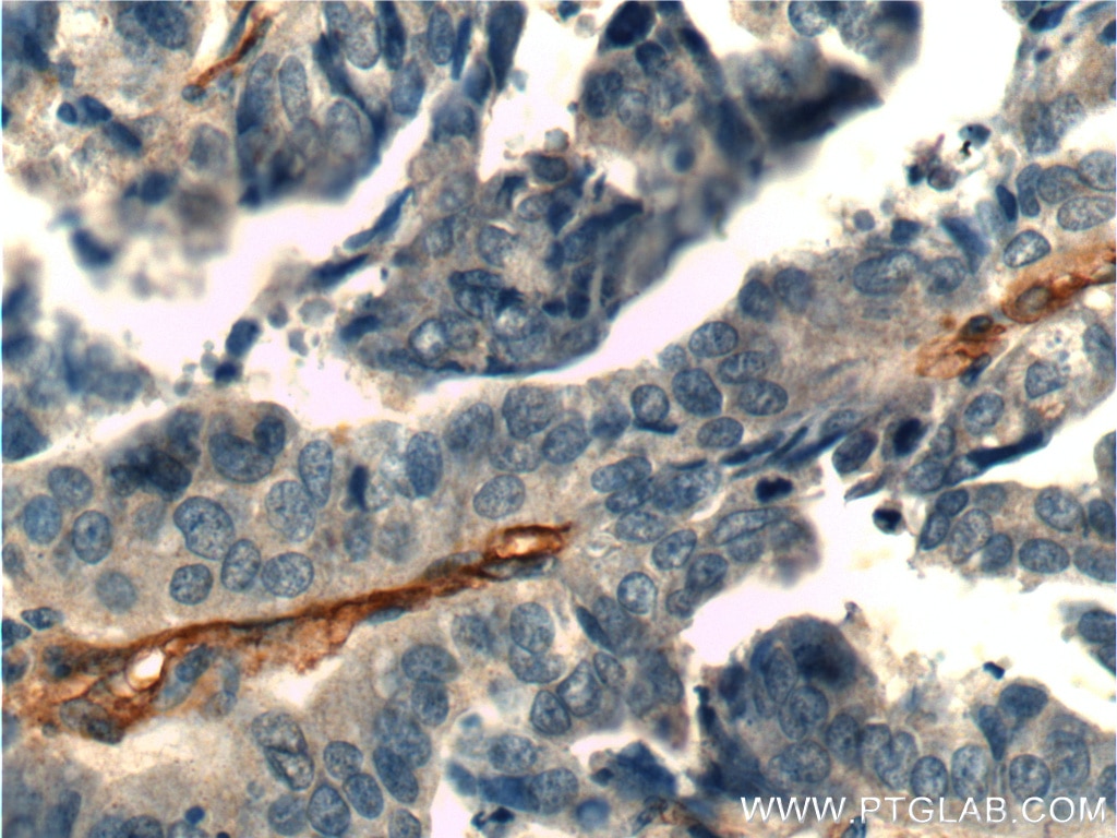 Immunohistochemistry (IHC) staining of human ovary tumor tissue using CD146/MCAM Polyclonal antibody (17564-1-AP)