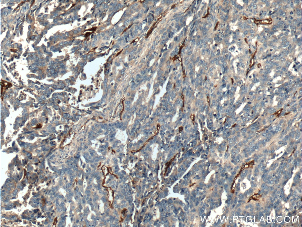 Immunohistochemistry (IHC) staining of human ovary tumor tissue using CD146/MCAM Polyclonal antibody (17564-1-AP)